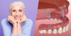 How Long Do Dental Implants Last, What Impacts the Duration?