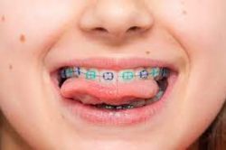 Braces Removal Process: What to Expect, If it Hurts