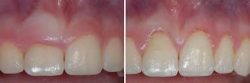 Do I Need a Crown Lengthening Procedure?