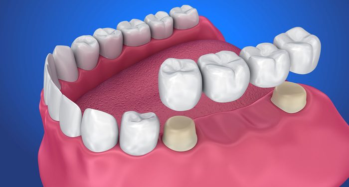 Cleaning Between the Teeth with a Floss Threader