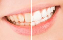 Teeth Whitening – Dental Clinic | Teeth Whitening Before And After | Before And After Teet ...