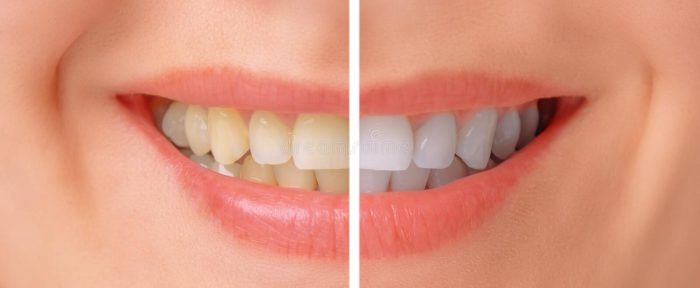 Teeth whitening results:Teeth Whitening Before And After | Before And After Teeth Whitening Photo