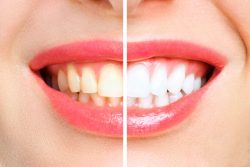 Teeth whitening results: Teeth Whitening Before And After | Before And After Teeth Whitening Photo