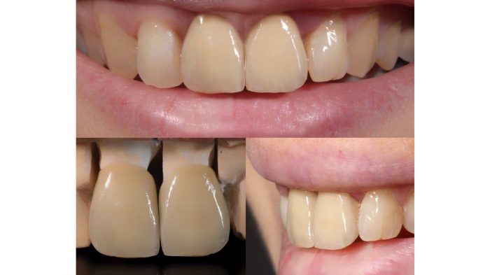 Porcelain Dental Crown | Single Front Tooth Crown