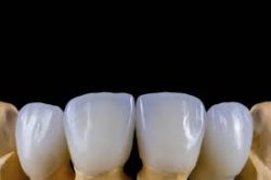 Single Front Tooth Crown Before And After | Porcelain Dental Crown