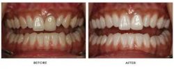 Single Front Tooth Crown: Porcelain Dental Crown