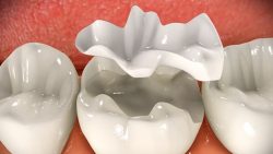 What Are Dental Inlays And Onlays?