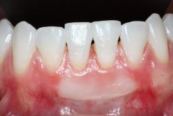 What Is A Dental Bone Graft?