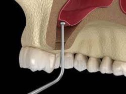 What You Need To Know About A Dental Bone Graft