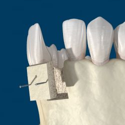 Bone Graft For Dental Implants: Understanding The Possibility