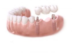 dental bone graft cost | Bone Grafting for Dental Implants