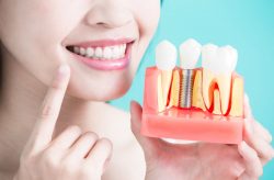 What Is A Removable Partial Denture?
