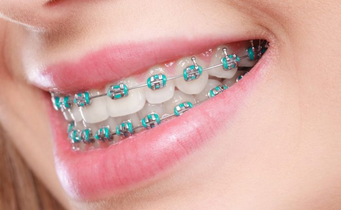 Traditional Metal Braces in Houston