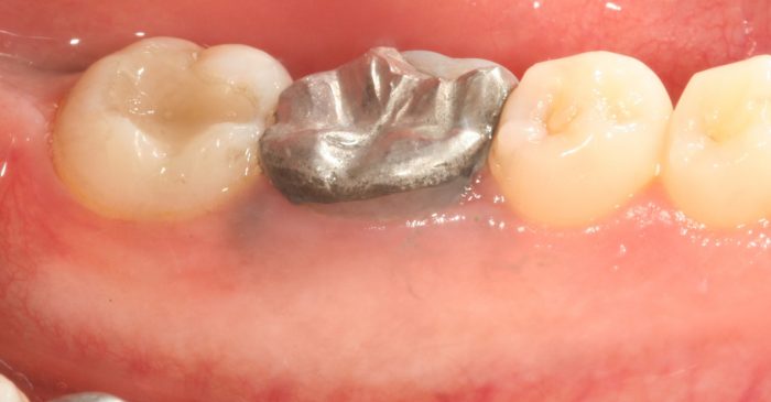 Crown Lengthening Surgery For Dentists