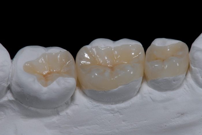 Difference Between Inlay and Onlay in Dentistry