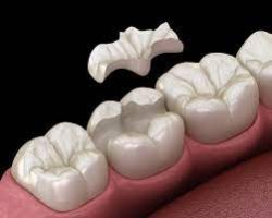Inlays and Onlays | Your Indirect Dental Filling Options
