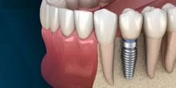 Dental bone graft: cost, procedure, and recovery