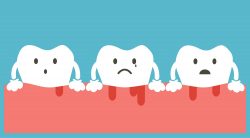Gingivitis: Symptoms, Causes and Treatments