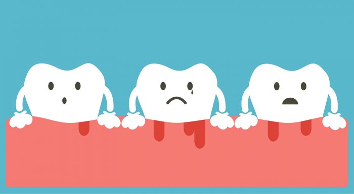 Gingivitis: Symptoms, Causes and Treatments