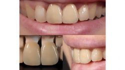Single Front Tooth Crown Before And After | Porcelain Crown and Bridges