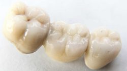 Single Front Tooth Crown Before And After