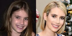 Celebrity Teeth Before And After | Before And After Celebrity Teeth