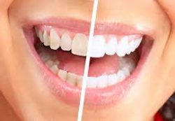 Teeth Whitening Houston TX |Professional Teeth Whitening Near Me