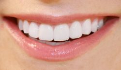 Laser Teeth Whitening – Houston