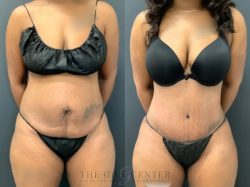 Tummy Tuck Before and After Pictures| Tummy Tuck Photos Before and After