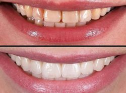 Dental Veneers | Sapphire Smiles Dentistry