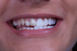 Porcelain Dental Veneers | Dentist in North Miami, FL