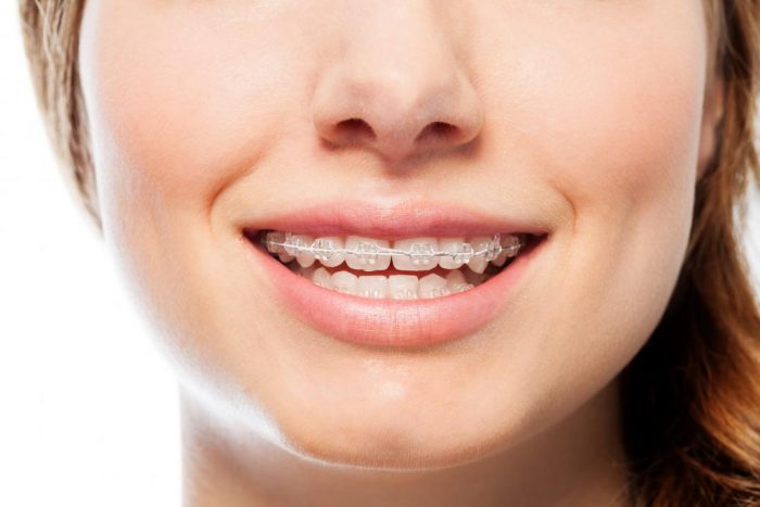 Get Straight Teeth Without Conventional Braces