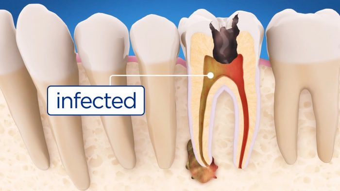 Root canal treatment – Better Health Channel | Eating After Root Canal Therapy