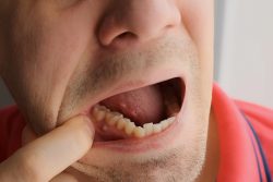 Treatment For An Abscessed Tooth | Emergency Tooth Infection Treatment