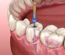 Treatment for Exposed Nerve in Tooth – Emergency Dentist In Houston