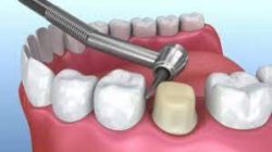 Dental Crowns: What Are They, Types, Procedure & Care
