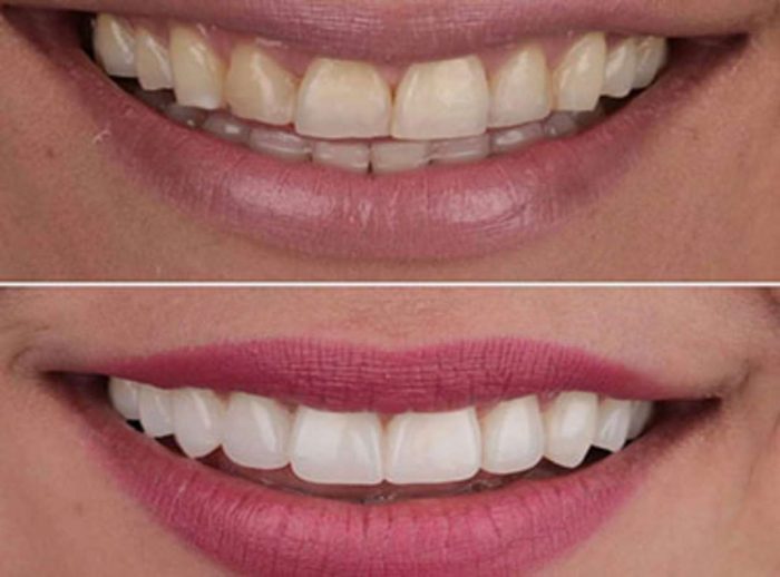 Porcelain Veneers Before and After | Porcelain Veneers Near Me