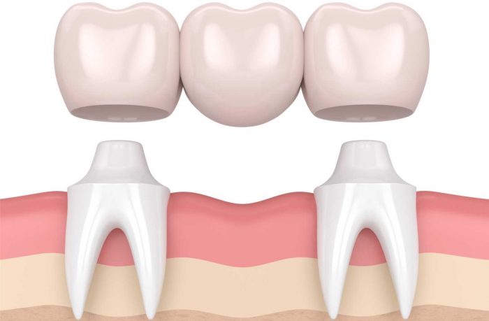 Dental Bridge Near Me | Cantilever Bridge Dental | Maryland Bridge Dental