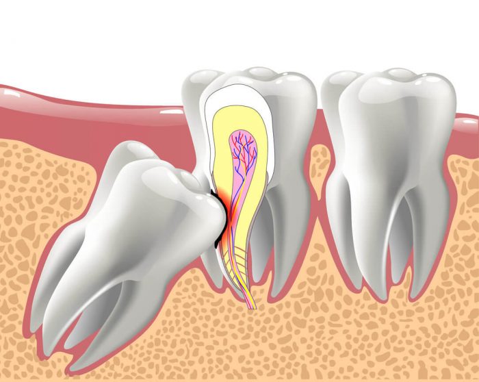 Wisdom Tooth Extractions – Houston, TX