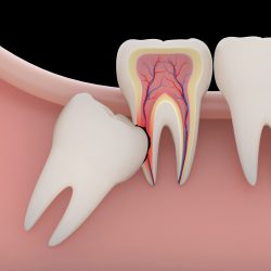 Wisdom Tooth Removal Cost
