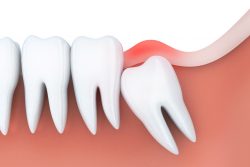 What If Your Wisdom Tooth Extraction Site Never Closed?