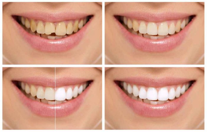 Cosmetic Dentistry in Houston, TX | Cosmetic Dentists of Houston | Houston’s Premier Denta ...