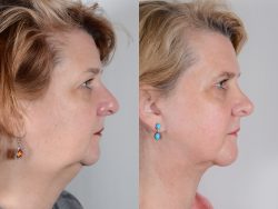 How Much Does a Neck Liposuction Cost – Premiere Surgical Art