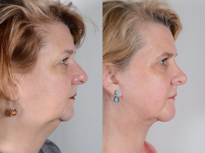 How Much Does a Neck Liposuction Cost – Premiere Surgical Art