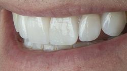 Teeth Veneers For Straight Teeth