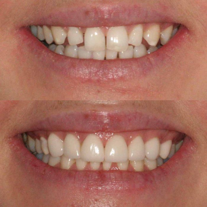 Temporary Veneers Vs No Prep Veneers | What Is A No-Prep Veneer?