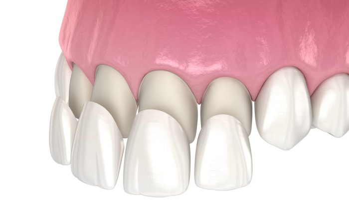 Temporary Veneers in Houston