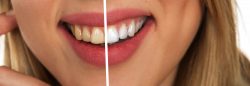 Top Rated Veneers Specialist Dentist