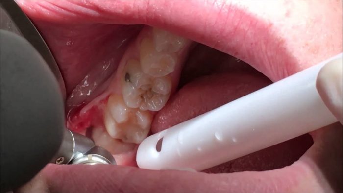 Infected Wisdom Tooth Extraction