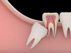 Dental Implants in Sunny Isles | Dental Implants Sunny Isles FL